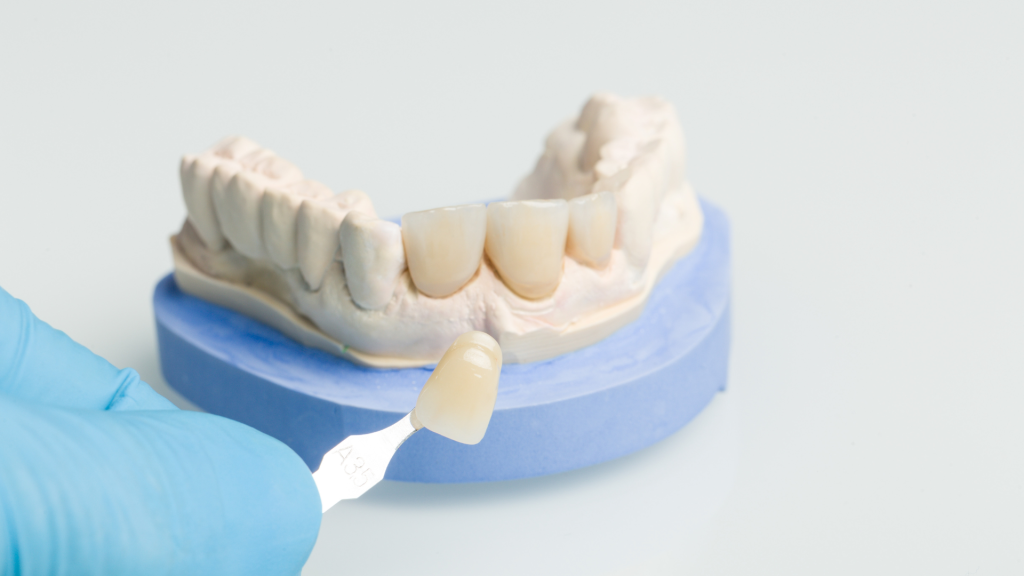 veneers