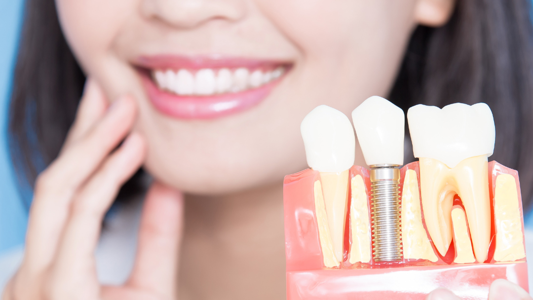 dental implants